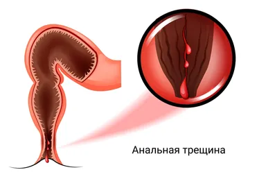 Анальная трещина — причины, симптомы и лечение заболевания