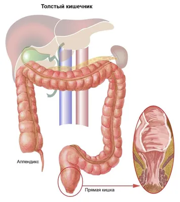 ТРЕЩИНА ПРЯМОЙ КИШКИ