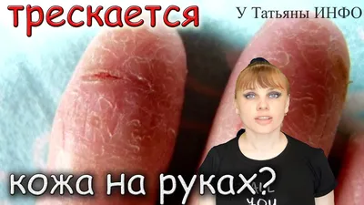 Шелушится кожа на ступнях ног – что делать, как лечить