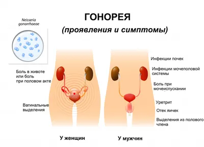 Женский триппер, медицинская концепция Иллюстрация штока - иллюстрации  насчитывающей бекона, патоген: 124561792