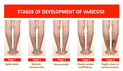 Венозные трофические язвы — лечение трофической язвы на ногах при варикозе  | Статьи и видео