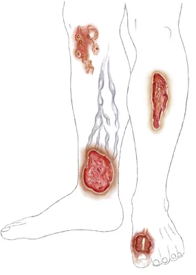 Трофическая язва: как с ней разобраться?
