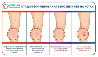 Лимфостаз ног (слоновая болезнь) - лечение, степени, осложнения,  профилактика