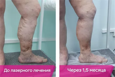 Степени, стадии и формы варикоза вен нижних конечностей - статьи  медицинского центра доктора Бегмы в Москве