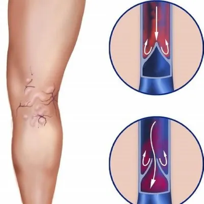 Начальная стадия варикоза на ногах — лечение | Статьи Детралекс