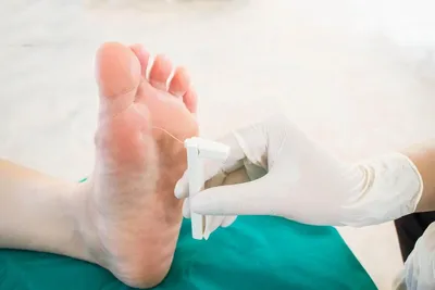 Трофическая язва: лечение, стадии, классификация - на голени, пальцах ног |  Медицинский центр ФлебоПлюс