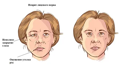 Невралгия тройничного нерва | симптомы, диагностика и лечение