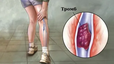 3 главных симптома тромбоза глубоких вен: флеботромбоз ног