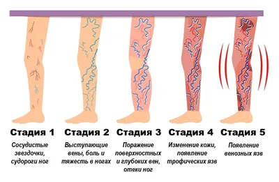 Тромбоз глубоких вен