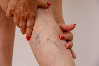 Симптомы тромба в ноге: как их определить и что делать