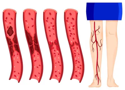 Тромбоз глубоких вен: симптомы, причины, диагноз и лечение