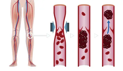Признаки и симптомы тромбоза глубоких вен