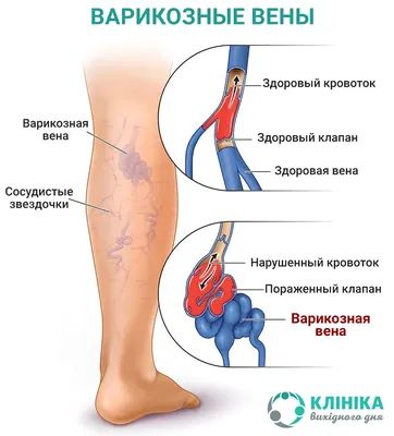 Тромбофлебит (тромбоз) вен нижних конечностей: лечение, симптомы, причины —  Медиленд