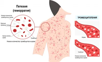 Тромбоцитопеническая пурпура фото