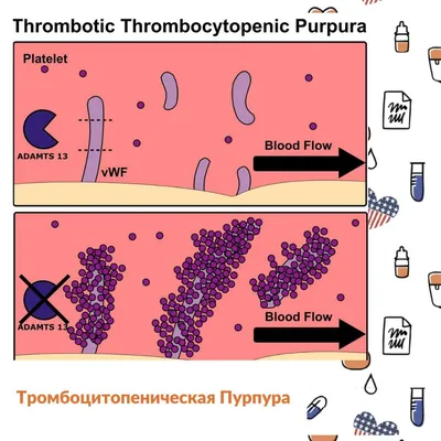 Тромбоцитопеническая Пурпура