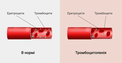 ИДИОПАТИЧЕСКАЯ ТРОМБОЦИТОПЕНИЧЕСКАЯ ПУРПУРА: ТЕЧЕНИЕ БЕРЕМЕННОСТИ И РОДОВ –  тема научной статьи по клинической медицине читайте бесплатно текст  научно-исследовательской работы в электронной библиотеке КиберЛенинка