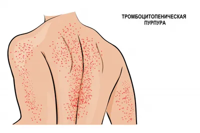 трамбоцитыамамамамам | Дипломная Хирургия | Docsity