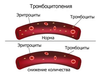 Тромбоцитопения. Классификация - презентация онлайн