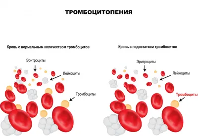 Тромбоцитопения: симптомы, причины, диагноз и лечение