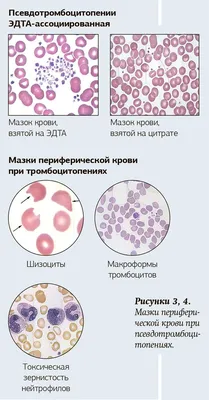 Практический подход к дифференциальной диагностике тромбоцитопений