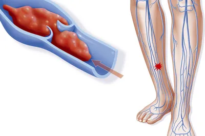 Тромбоз - лечение и профилактика в СЗАО (м.Щукинская, м.Стрешнево, м.Сокол)