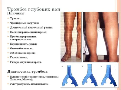 Dr. Эсекеев - Тромбоз глубоких вен (ТГВ) - это заболевание, при котором в  просвете глубоких вен образовываются сгустки крови (тромбы). В основном  страдают нижние конечности, так как отток венозной крови по ним