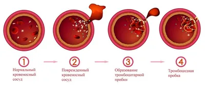 Венозный тромбоз –... - Kyrgyz Turk International Hospital | Facebook