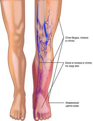 Как распознать тромбоз и тромбофлебит — блог медицинского центра ОН Клиник