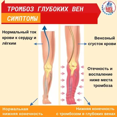 Риск тромбозов от коронавируса выше, чем после вакцинации, заявили ученые -  РИА Новости, 27.08.2021