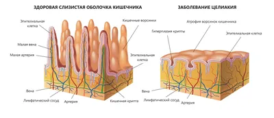 Кишечная микробиота и пробиотики при целиакии