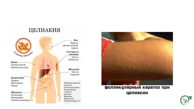 Целиакия – важная проблема современной гастроэнтерологии uMEDp