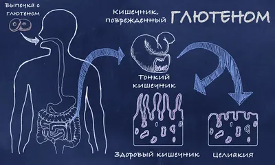 Издательство \"Династия\" - Целиакия в Ставропольском крае СТАТЬЯ В ОТКРЫТОМ  ДОСТУПЕ! Цель исследования. Анализ динамики распространенности целиакии у  детей и подростков в Ставропольском крае на протяжении последних 20 лет на  фоне совершенствования