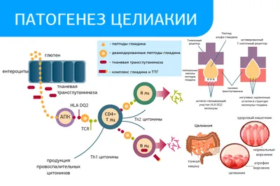 Что такое целиакия и как ее лечить? | Виола