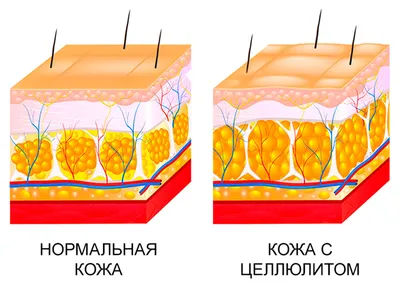 Методы борьбы с отечным целлюлитом