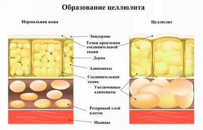 Целлюлит. ТОП-5 процедур против целлюлита