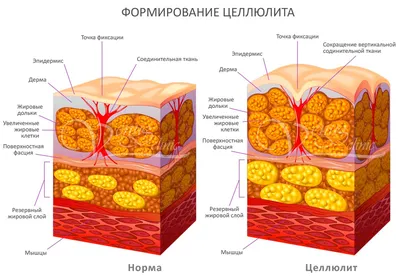 Средства в борьбе с целлюлитом и растяжками - «Убрать ужасный целлюлит  реально! Результаты До и После 😳. Самые эффективные и простые способы  убрать целлюлит в домашних условиях💣» | отзывы