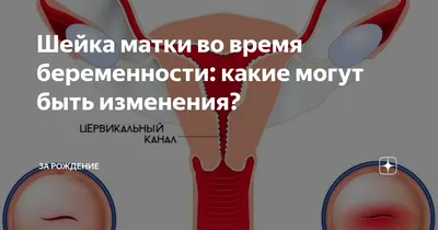 Медицинский центр ЛЕО - 📢 УДАЛЕНИЕ ПОЛИПА ЦЕРВИКАЛЬНОГО КАНАЛА  Цервикальный канал представляет собой удлиненную полость, которая соединяет  матку с влагалищем. На полипы в этой части тела приходится приблизительно  треть всех доброкачественных ...