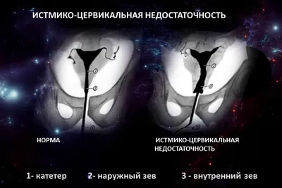 Гистерорезекция полипов цервикального канала | «Бест Клиник»