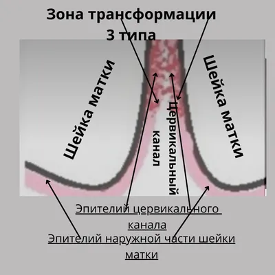 МИФ 3 \"ФДТ загоняет ВПЧ и атипичные клетки в цервикальный канал\" |  Афанасьев Максим Станиславович | Дзен