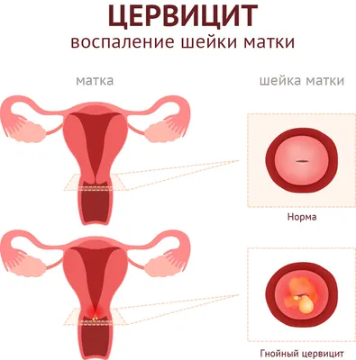 Шейка матки — Википедия