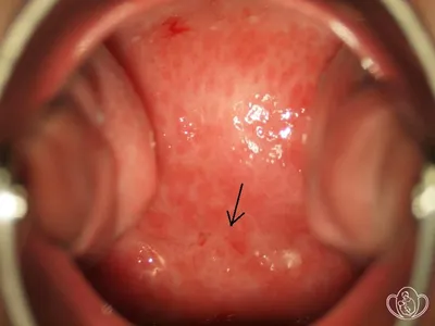 Цервицит, эндоцервицит: ФОТО, эффективное лечение | Курортная клиника  женского здоровья