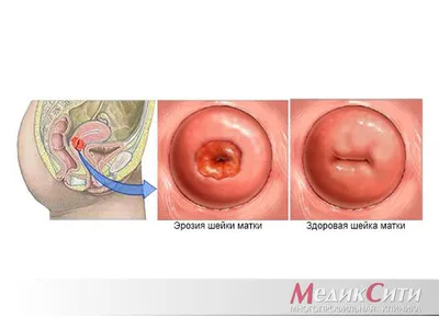Цервицит: причины, симптомы, лечение и диагностика