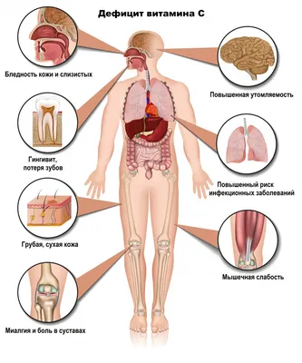 Цинга - причины появления, симптомы заболевания, диагностика и способы  лечения