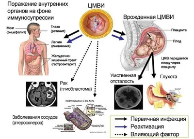 Цитомегаловирус: симптомы, у детей, при беременности, лечение