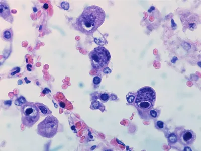 Цитомегаловирус в крови стоковое изображение. изображение насчитывающей  зеленый - 138133557