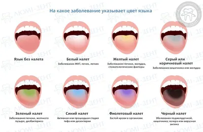 ВИЧ-инфекция: проявления в области рта при СПИДеDENTALMAGAZINE.RU