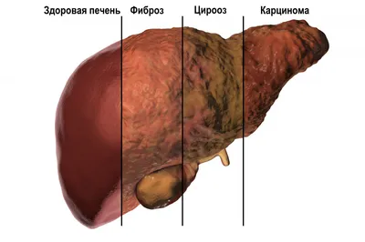 Желтуха, гепатит и цирроз печени - симптомы, диагностика и лечение