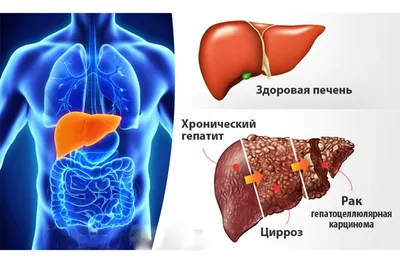 Гепатит А: симптомы, диагностика, лечение - Городская поликлиника №17