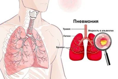 Пневмония