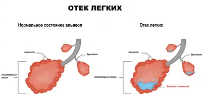 Пневмония, типичная и не очень: кашлять — не обязательно! - РМОО ВСТРЕЧА